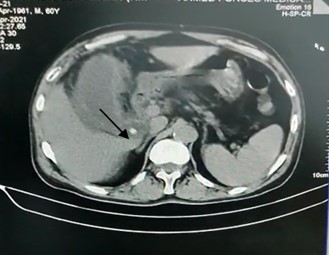 gall bladder with the stone inside