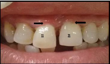 Maxillary lateral incisor with cracks (labial view). (a) Craze lines on