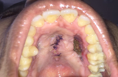 Nasal Myiasis: Case Report and Literature Review