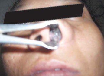 Clinical picture of malignant melanoma nose